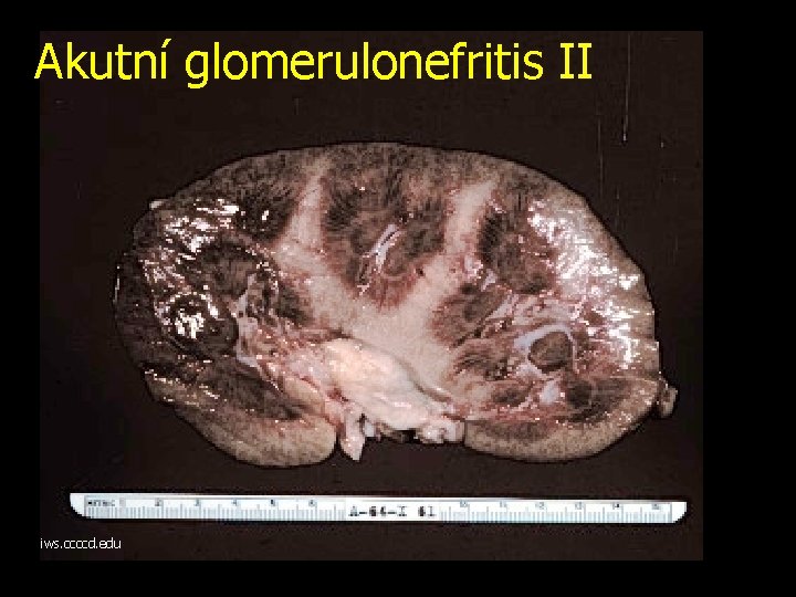 Akutní glomerulonefritis II iws. ccccd. edu 