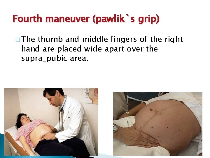Fourth maneuver (pawlik`s grip) � The thumb and middle fingers of the right hand