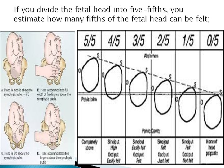 If you divide the fetal head into five-fifths, you estimate how many fifths of
