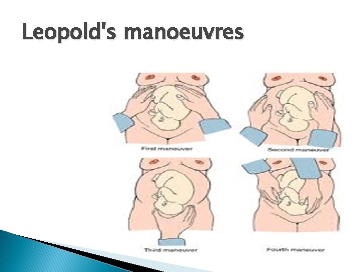Leopold's manoeuvres 
