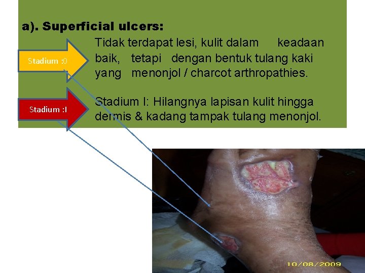 a). Superficial ulcers: Tidak terdapat lesi, kulit dalam keadaan baik, tetapi dengan bentuk tulang