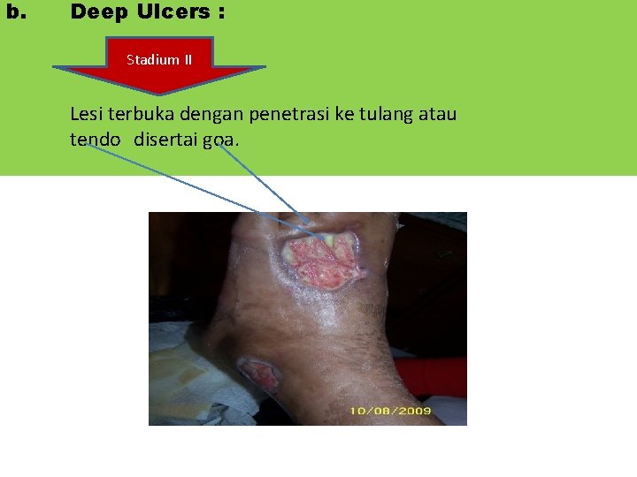 b. Deep Ulcers : Stadium II Lesi terbuka dengan penetrasi ke tulang atau tendo