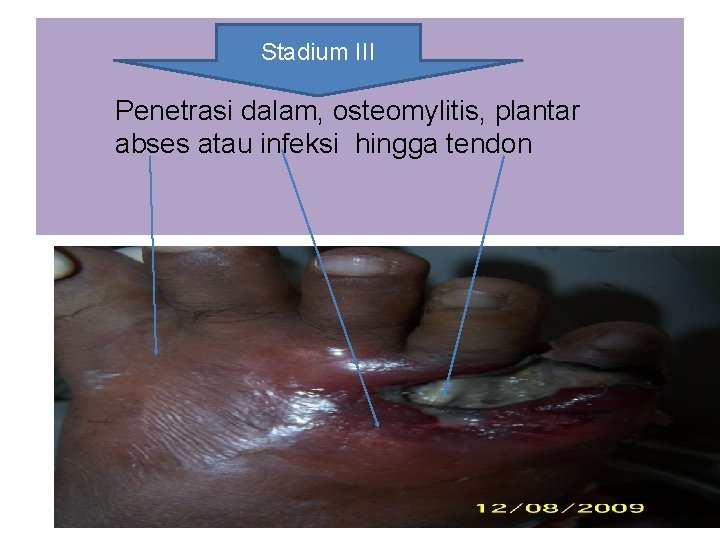 Stadium III Penetrasi dalam, osteomylitis, plantar abses atau infeksi hingga tendon 