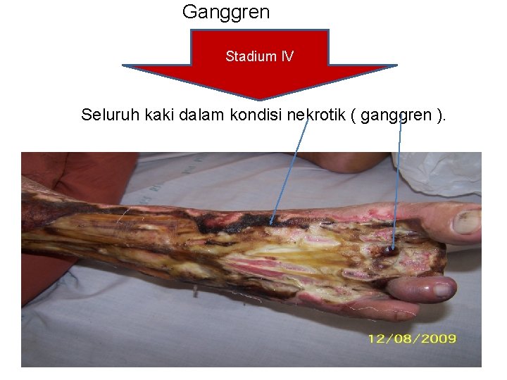 Ganggren Stadium IV Seluruh kaki dalam kondisi nekrotik ( ganggren ). 