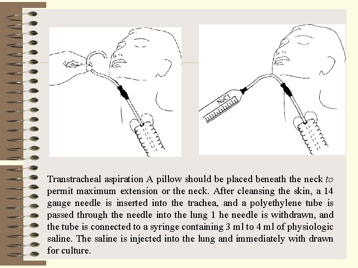 Transtracheal aspiration A pillow should be placed beneath the neck to permit maximum extension