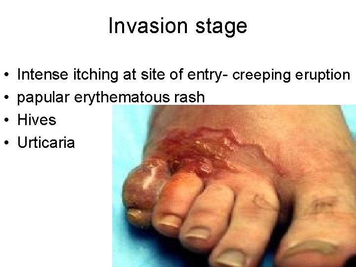 Invasion stage • • Intense itching at site of entry- creeping eruption papular erythematous