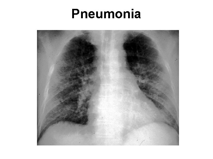 Pneumonia 