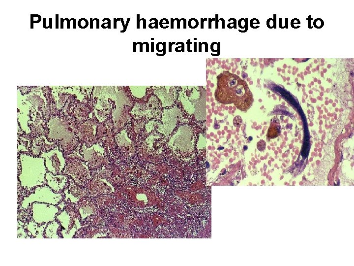 Pulmonary haemorrhage due to migrating 