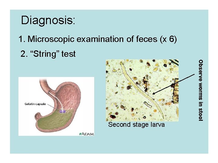Diagnosis: 1. Microscopic examination of feces (x 6) 2. “String” test Observe worms in
