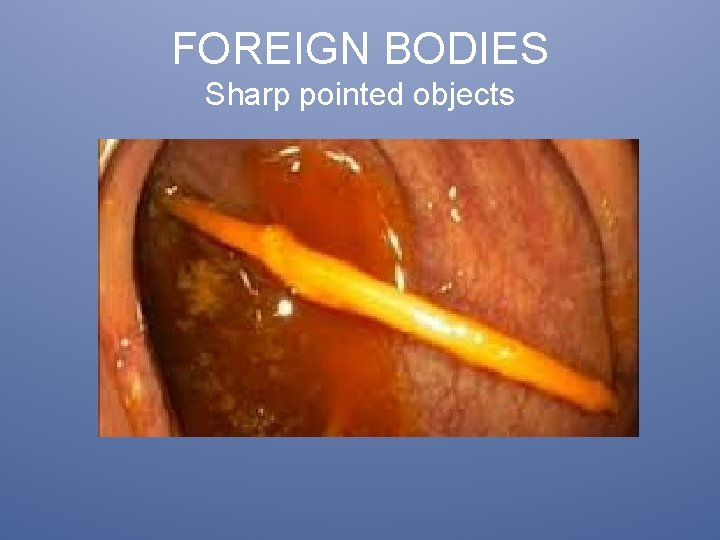 FOREIGN BODIES Sharp pointed objects 
