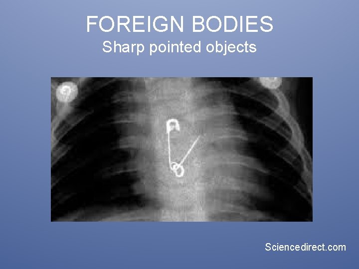 FOREIGN BODIES Sharp pointed objects Sciencedirect. com 