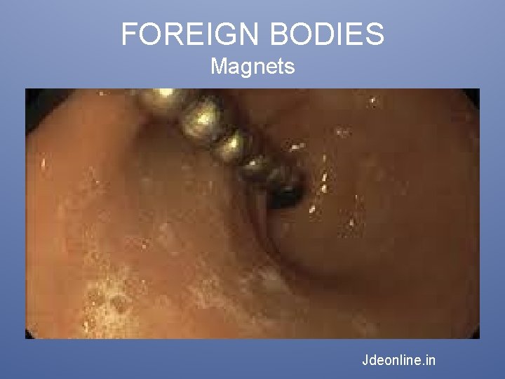 FOREIGN BODIES Magnets Jdeonline. in 