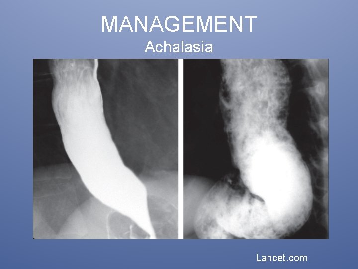 MANAGEMENT Achalasia Lancet. com 