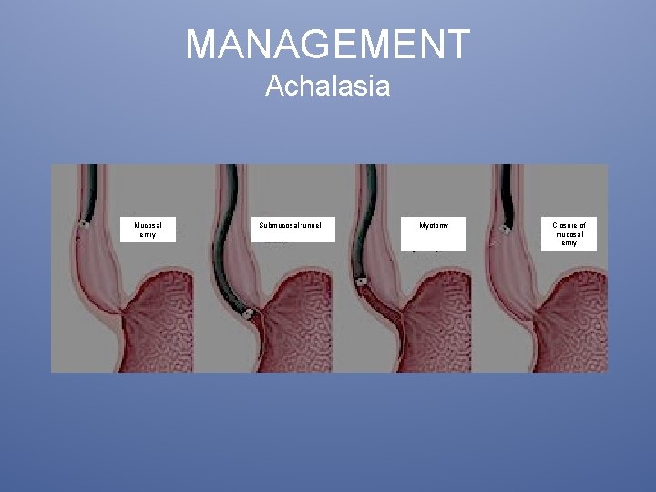 MANAGEMENT Achalasia Mucosal entry Submucosal tunnel Myotomy Closure of mucosal entry 