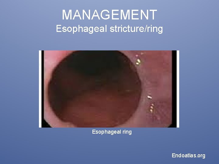 MANAGEMENT Esophageal stricture/ring Esophageal ring Endoatlas. org 