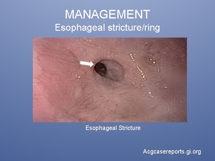 MANAGEMENT Esophageal stricture/ring Esophageal Stricture Acgcasereports. gi. org 