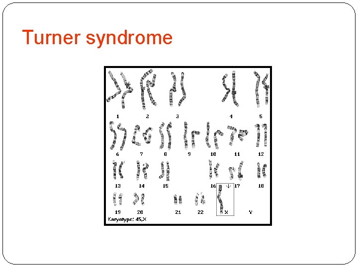 Turner syndrome 