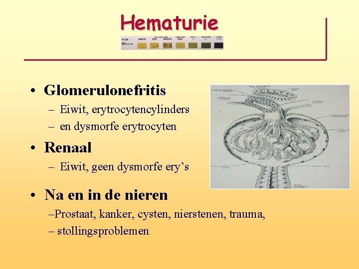 Hematurie • Glomerulonefritis – Eiwit, erytrocytencylinders – en dysmorfe erytrocyten • Renaal – Eiwit,