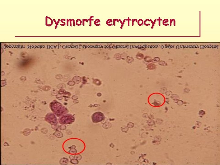 Dysmorfe erytrocyten 