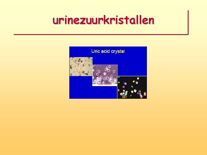 urinezuurkristallen 