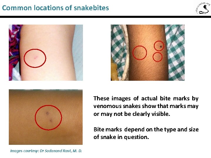 Common locations of snakebites Saw-Scaled Viper These images of actual bite marks by venomous