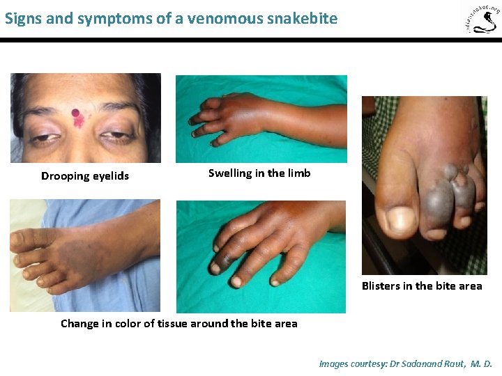 Signs and symptoms of a venomous snakebite Saw-Scaled Viper Drooping eyelids Swelling in the