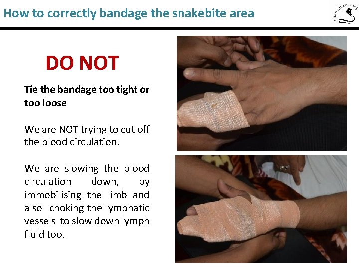 How to correctly bandage the snakebite area Saw-Scaled Viper DO NOT Tie the bandage