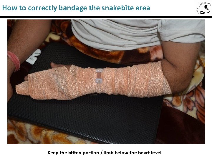 How to correctly bandage the snakebite area Keep the bitten portion / limb below