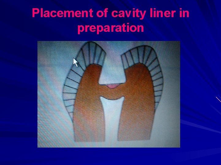 Placement of cavity liner in preparation 