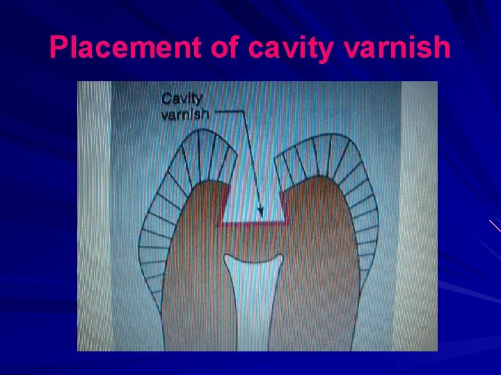 Placement of cavity varnish 