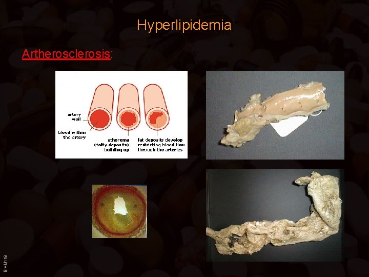 Hyperlipidemia BIMM 118 Artherosclerosis: 