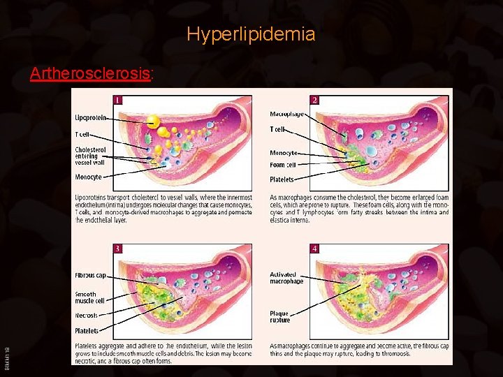 Hyperlipidemia BIMM 118 Artherosclerosis: 