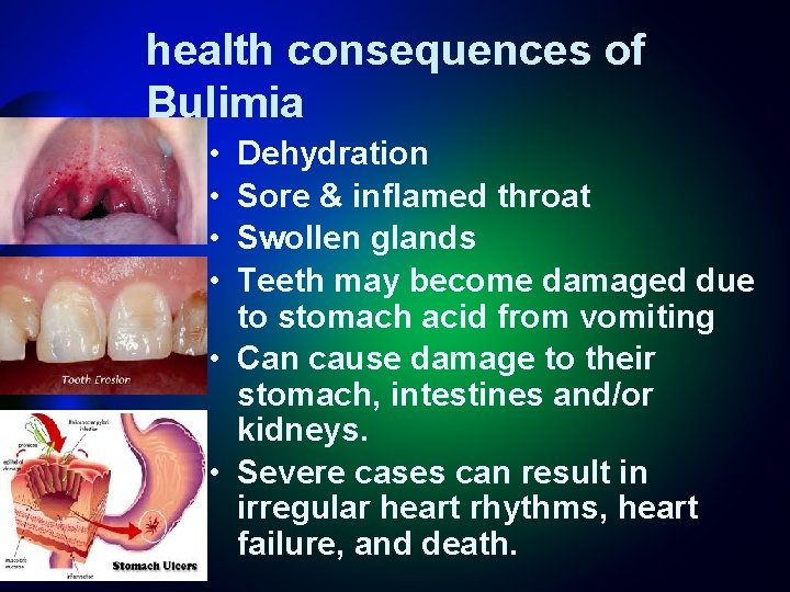 health consequences of Bulimia • • Dehydration Sore & inflamed throat Swollen glands Teeth