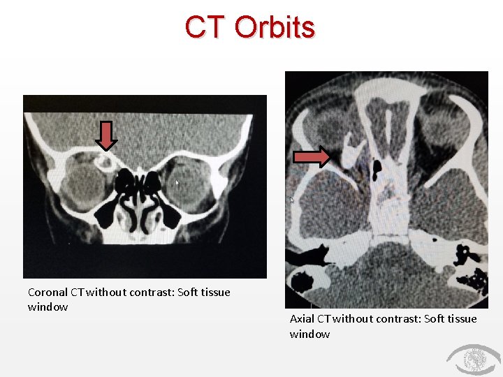 CT Orbits Coronal CT without contrast: Soft tissue window Axial CT without contrast: Soft