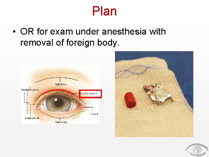 Plan • OR for exam under anesthesia with removal of foreign body. 