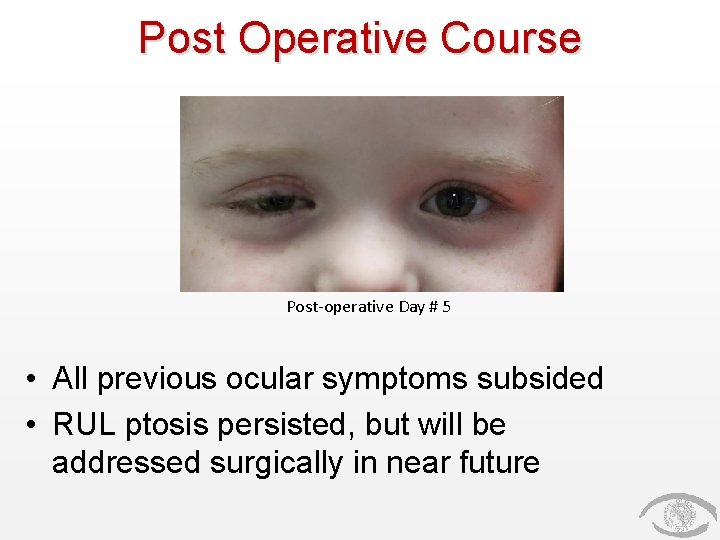 Post Operative Course Post-operative Day # 5 • All previous ocular symptoms subsided •