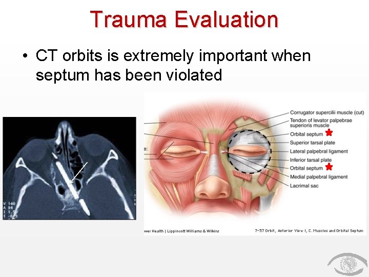 Trauma Evaluation • CT orbits is extremely important when septum has been violated 