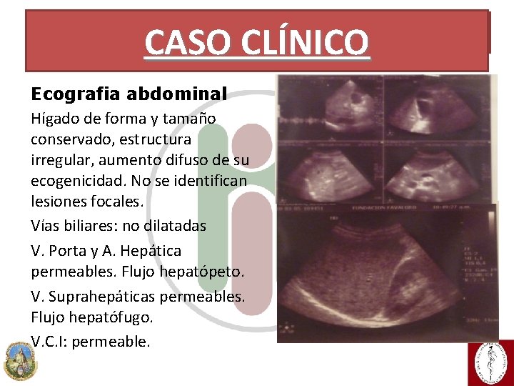 CASO CLÍNICO Ecografia abdominal Hígado de forma y tamaño conservado, estructura irregular, aumento difuso