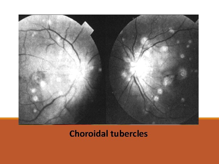 Choroidal tubercles 