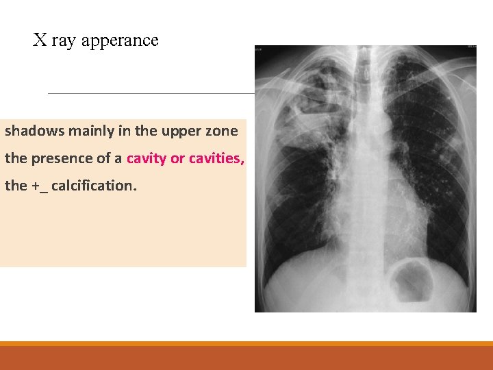 X ray apperance shadows mainly in the upper zone the presence of a cavity