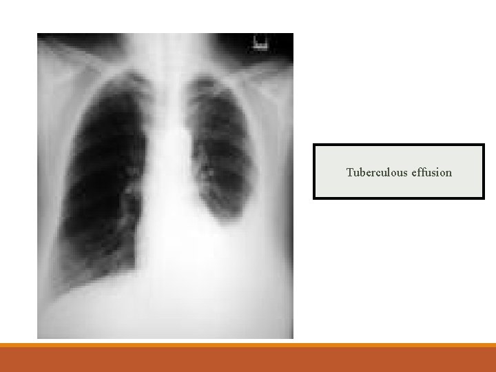 Tuberculous effusion 