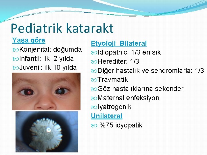 Pediatrik katarakt Yaşa göre Konjenital: doğumda Infantil: ilk 2 yılda Juvenil: ilk 10 yılda