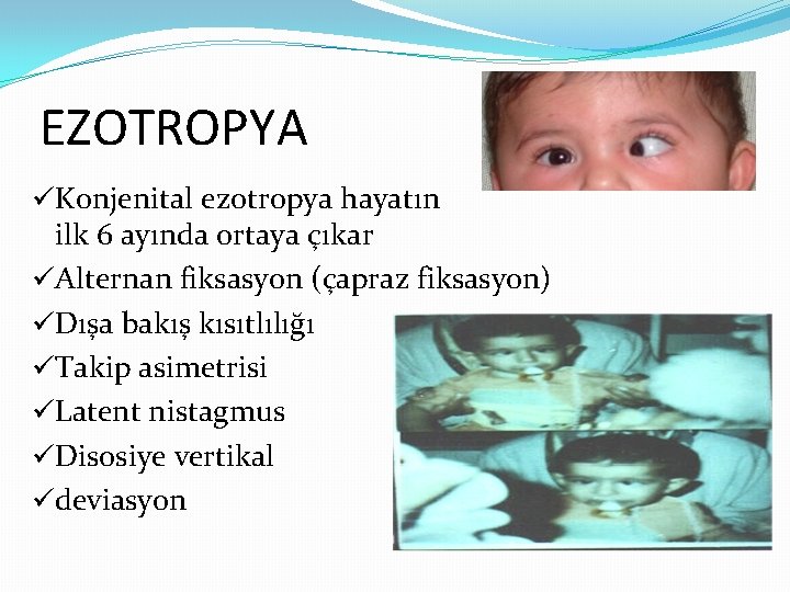 EZOTROPYA üKonjenital ezotropya hayatın ilk 6 ayında ortaya çıkar üAlternan fiksasyon (çapraz fiksasyon) üDışa