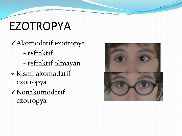 EZOTROPYA üAkomodatif ezotropya - refraktif olmayan üKısmi akomadatif ezotropya üNonakomodatif ezotropya 