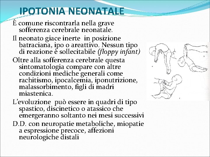IPOTONIA NEONATALE È comune riscontrarla nella grave sofferenza cerebrale neonatale. Il neonato giace inerte