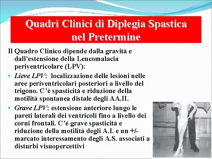 Quadri Clinici di Diplegia Spastica nel Pretermine Il Quadro Clinico dipende dalla gravità e