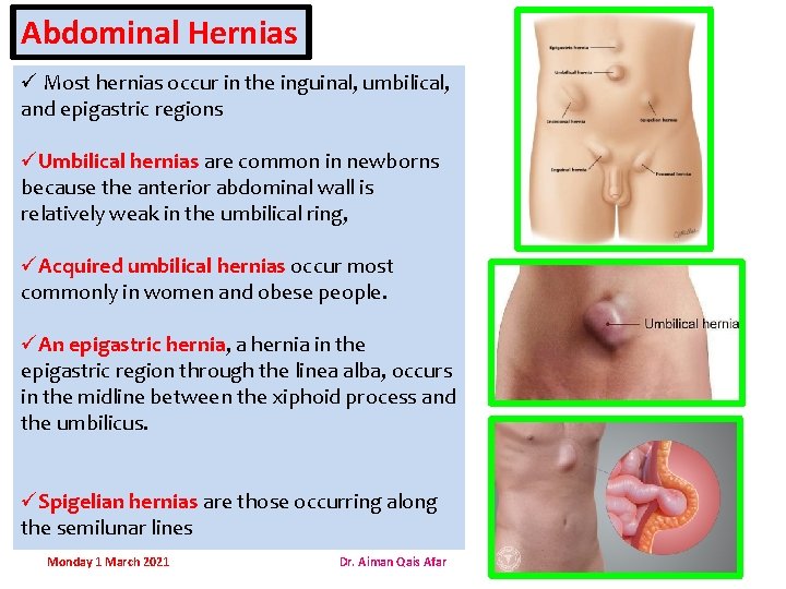 Abdominal Hernias ü Most hernias occur in the inguinal, umbilical, and epigastric regions üUmbilical