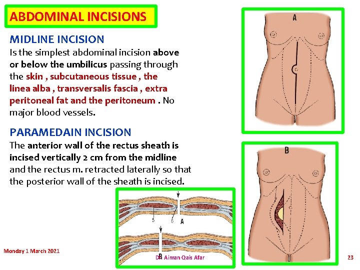 ABDOMINAL INCISIONS MIDLINE INCISION Is the simplest abdominal incision above or below the umbilicus