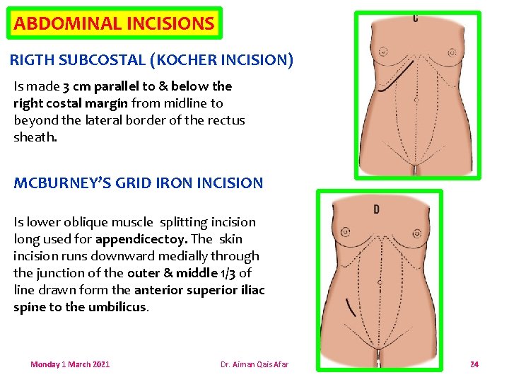 ABDOMINAL INCISIONS RIGTH SUBCOSTAL (KOCHER INCISION) Is made 3 cm parallel to & below