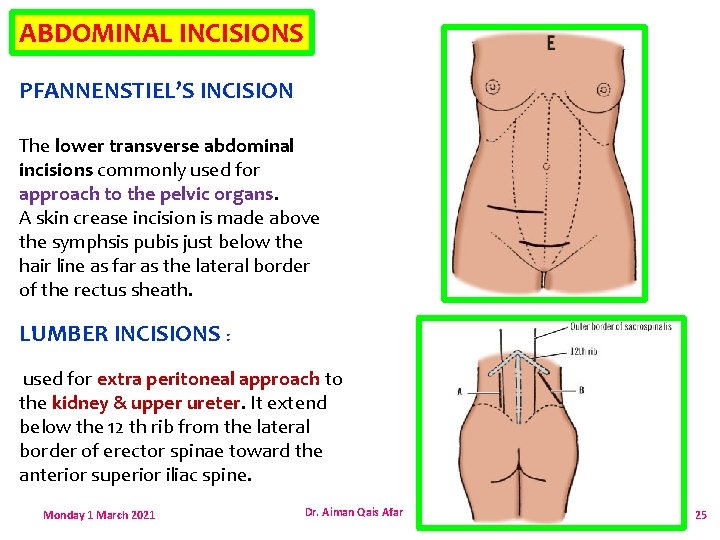 ABDOMINAL INCISIONS PFANNENSTIEL’S INCISION The lower transverse abdominal incisions commonly used for approach to